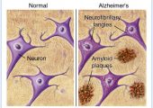 Plaques between neurons is one of the indicators of Alzheimer's Disease and seem to be increased with GCR exposure (Credits: American Health Assistance Foundation).